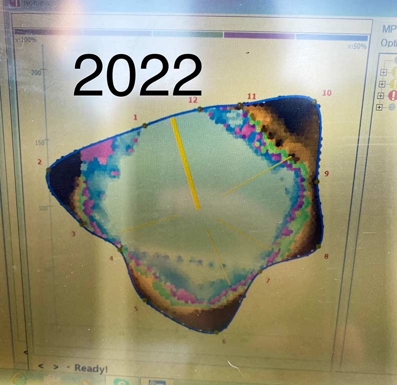 Tomograph image from 2022, note the hugely increased area of blue, decayed wood taking up almost the entire trunk